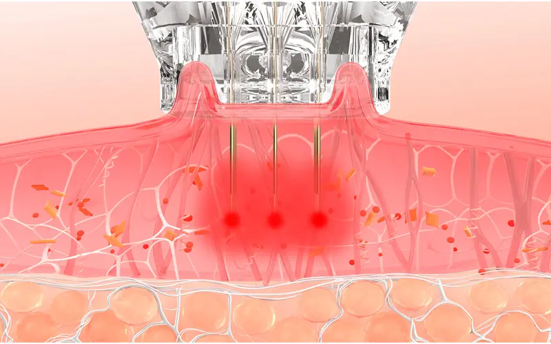 Microneedle Vacuum Adsorption
