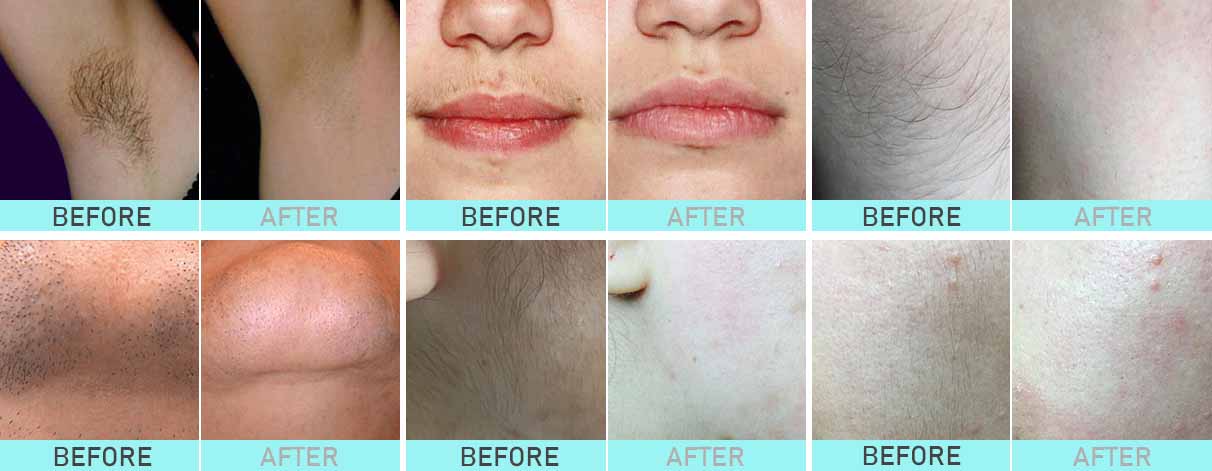 Diode laser Hair Removal treatment