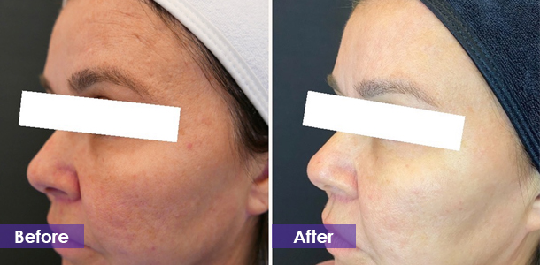 Microneedle Fractional RF Skin Rejuvenation before and after