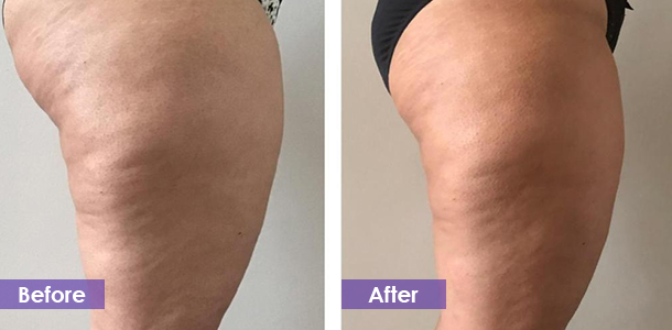 Leg lipolysis and plastic surgery before and after