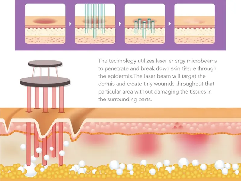 CO2 lasers Working Principle