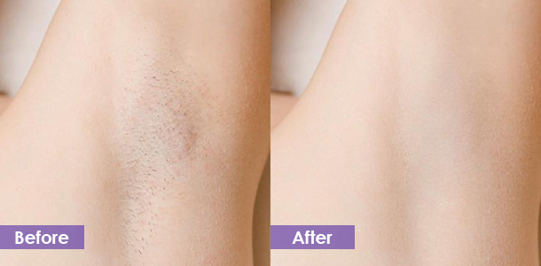 Underarm hair removal