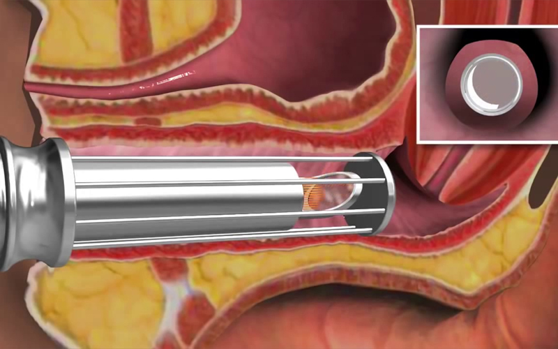 CO2 laser Vaginal Mode