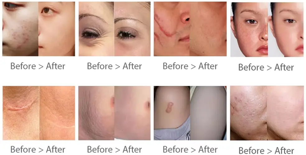 FOTONA 4D Scar removal before and after