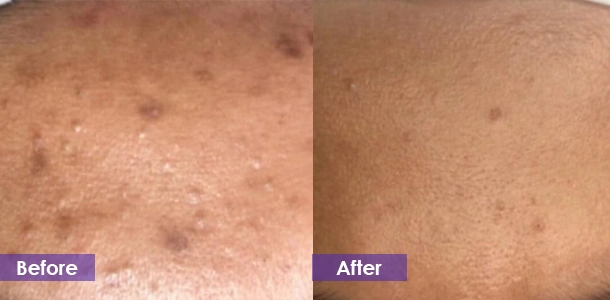 Morpheus8 Acne Scar Removal before and after