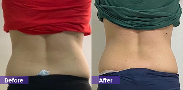 Cryolipolysis before and after waist fat reduction