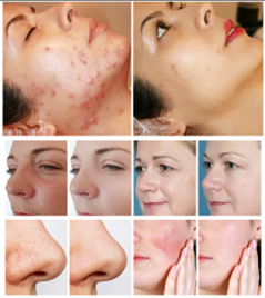 Before and after acne treatment photos
