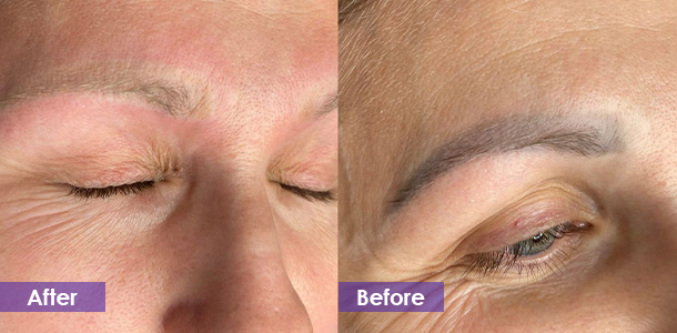 Eyebrow Tattoo Removal