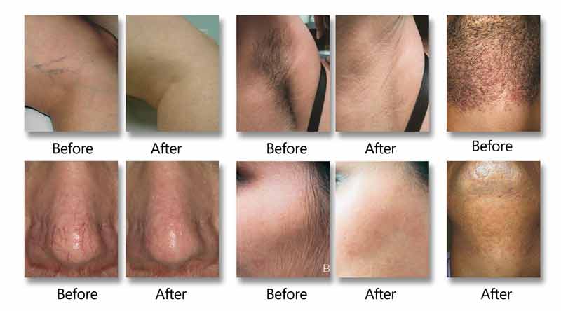 Alexandrite Laser Hair Removal before and after