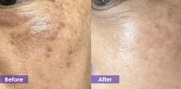 face pigmentation removal before and after