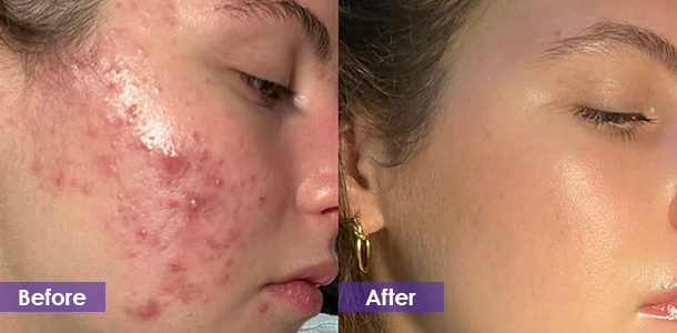 Microneedle Fractional RF Acne treatment before and after