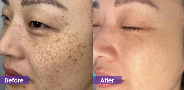 Pico laser spot removal before and after