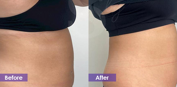 Abdominal lipolysis and plastic surgery before and after
