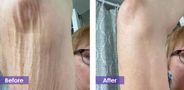 Tight arms before and after