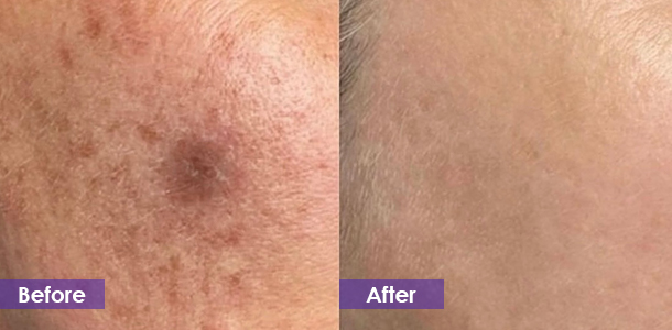 Facial pigmentation removal before and after