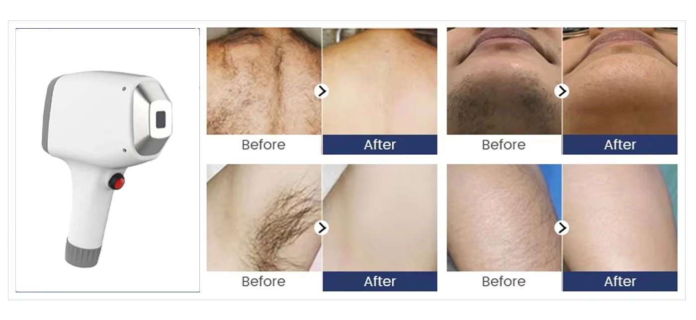 diode laser hair removal before and after