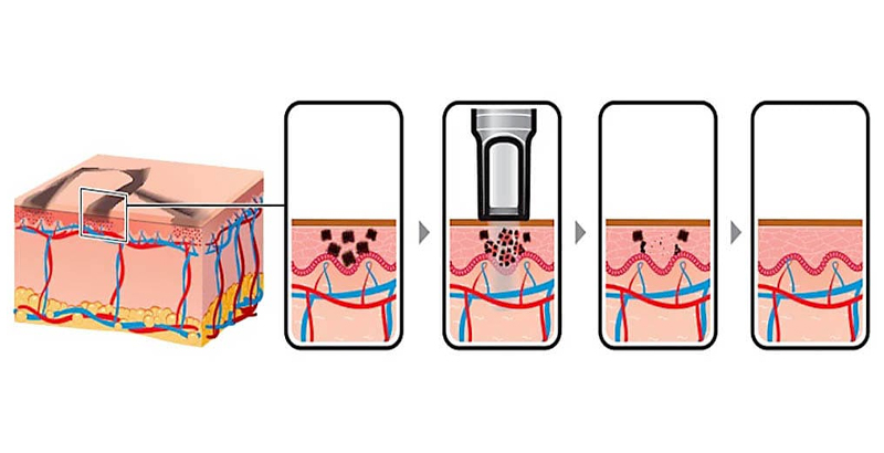 Q-switched Nd:YAG laser how it work