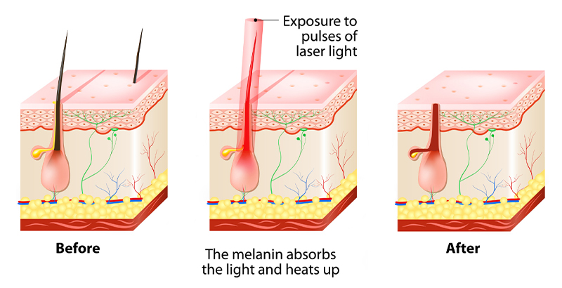 diode laser how it work