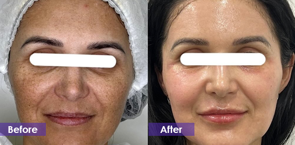 Pico laser pigmentation removal before and after