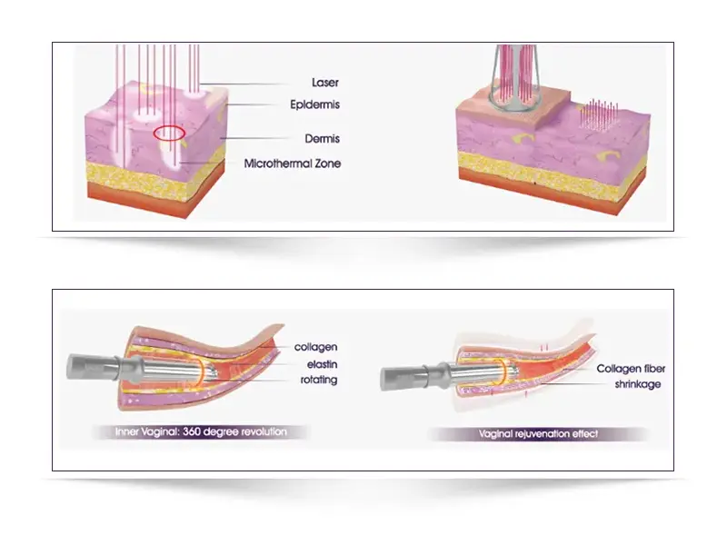 How Fractional co2 laser machine Work