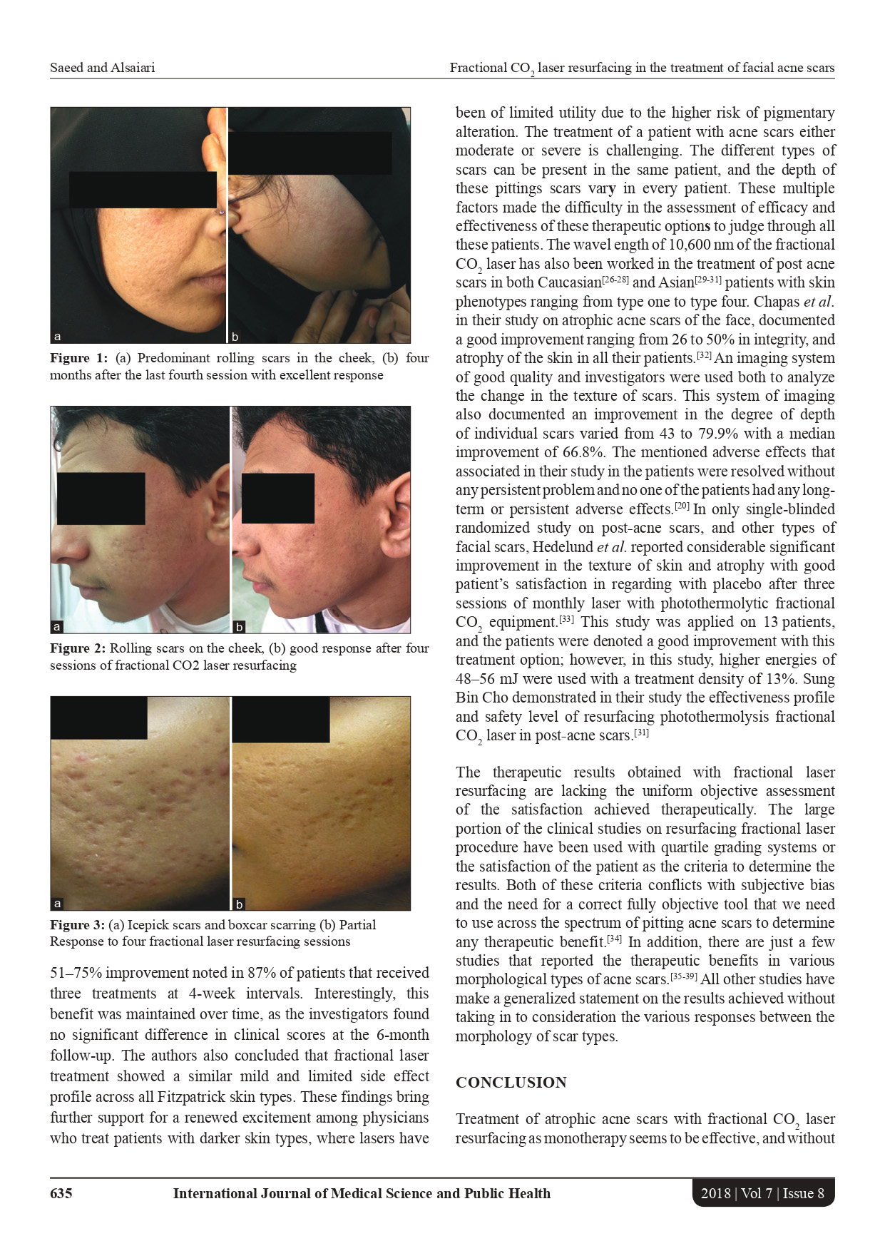 The efficacy of fractional CO2 laser resurfacing in the treatment of facial acne scars