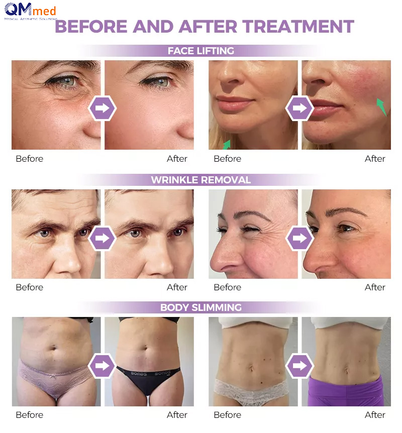 Ultralift HIFU Machine Before and After