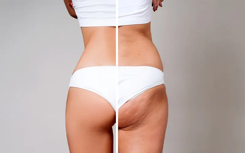 Reduce cellulite