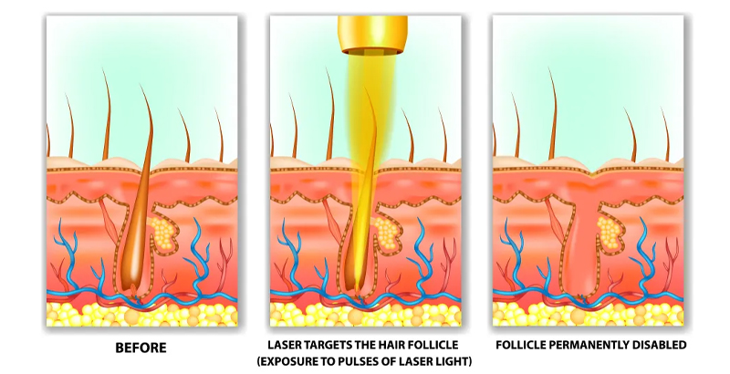How Diode Laser work?