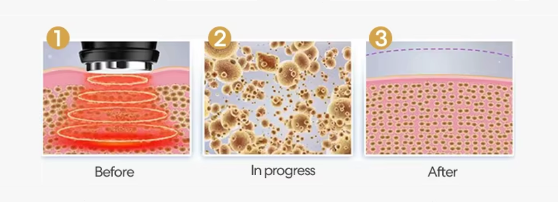 40KHz Cavitation Technology