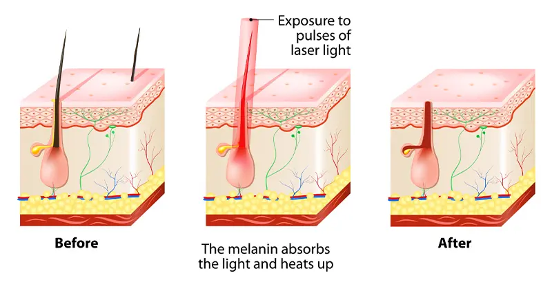 How Triple-Wavelength Epilation Diode Lasers Work