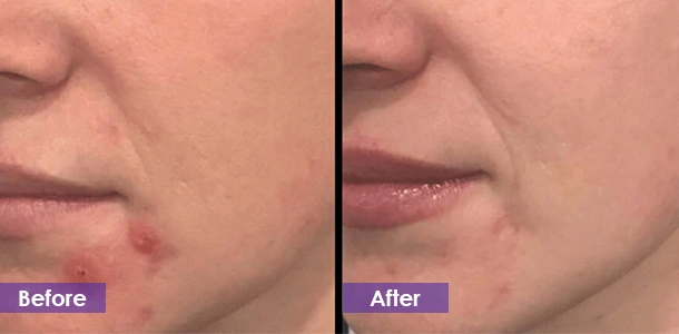 Purify pores before and after