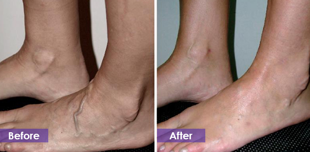 Varicose vein removal on the soles of the feet