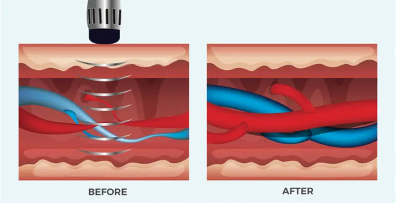 How Shockwave works?