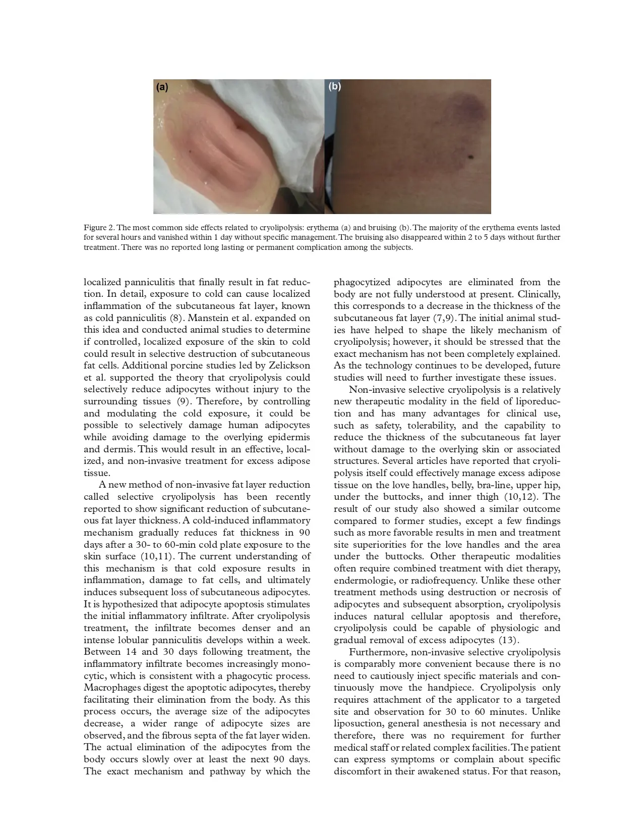 Clinical effectiveness of non-invasive selective cryolipolysis
