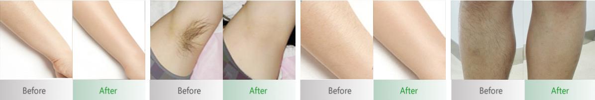 Diode laser Hair Removal before and after