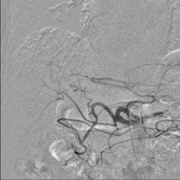 the mobile c arm's digital subtraction angiography.