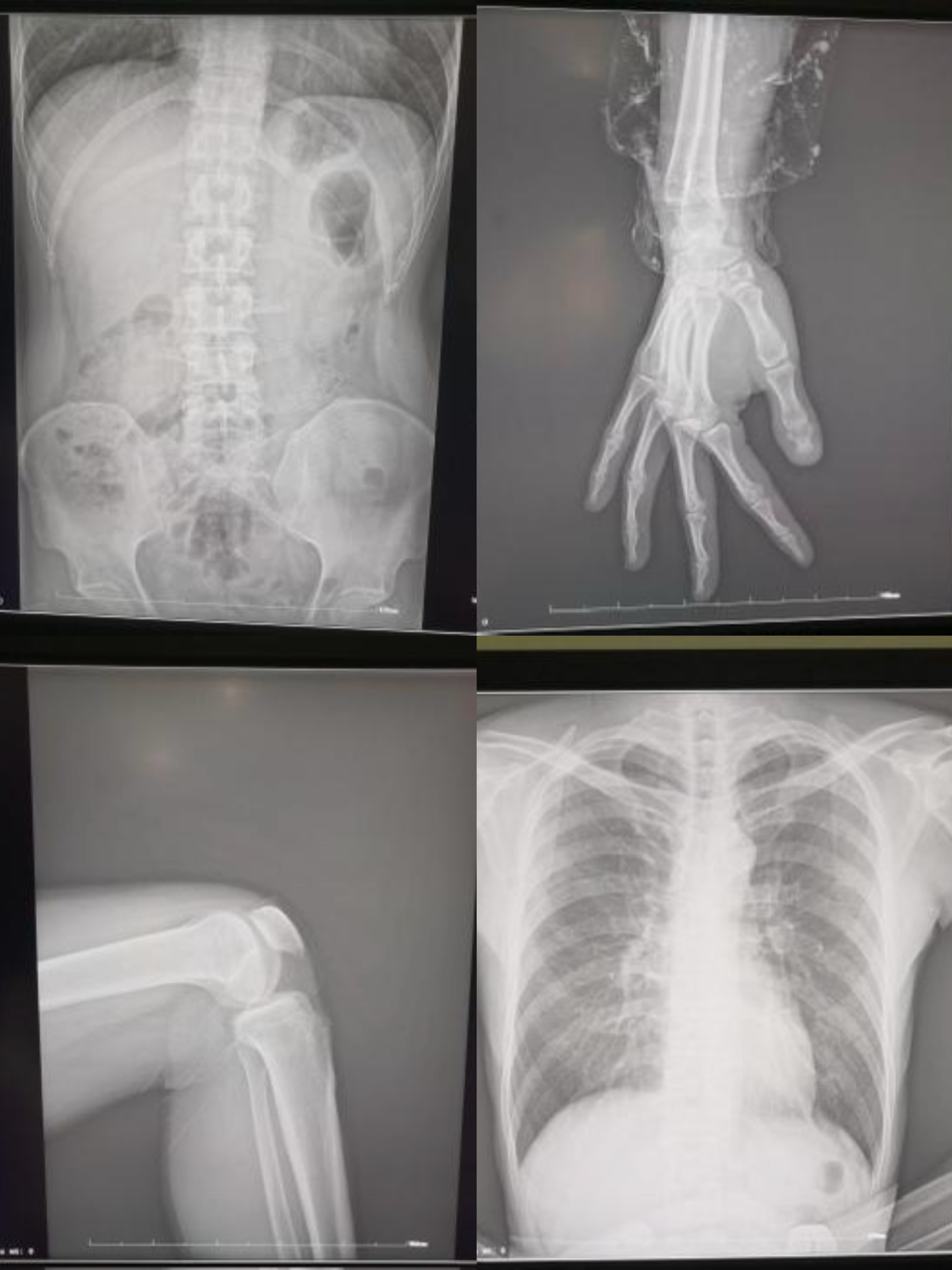clinical x ray images from the the mobile dr.