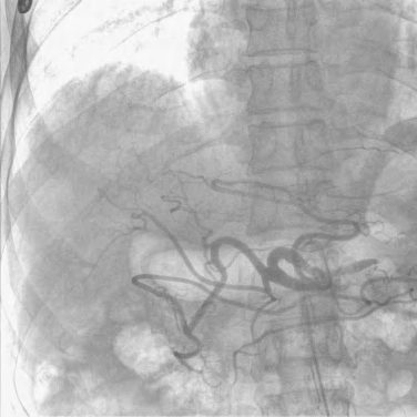 digital subtraction angiography of the mobile c arm.