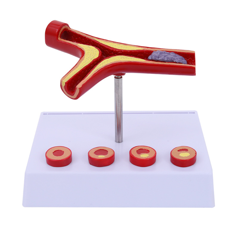 Anatomical Model Manikin Atherosclerosis Display Teaching Model Human Atherosclerosis Anatomical Model The Mannequin Display Atherosclerosis Model Teaching Aids