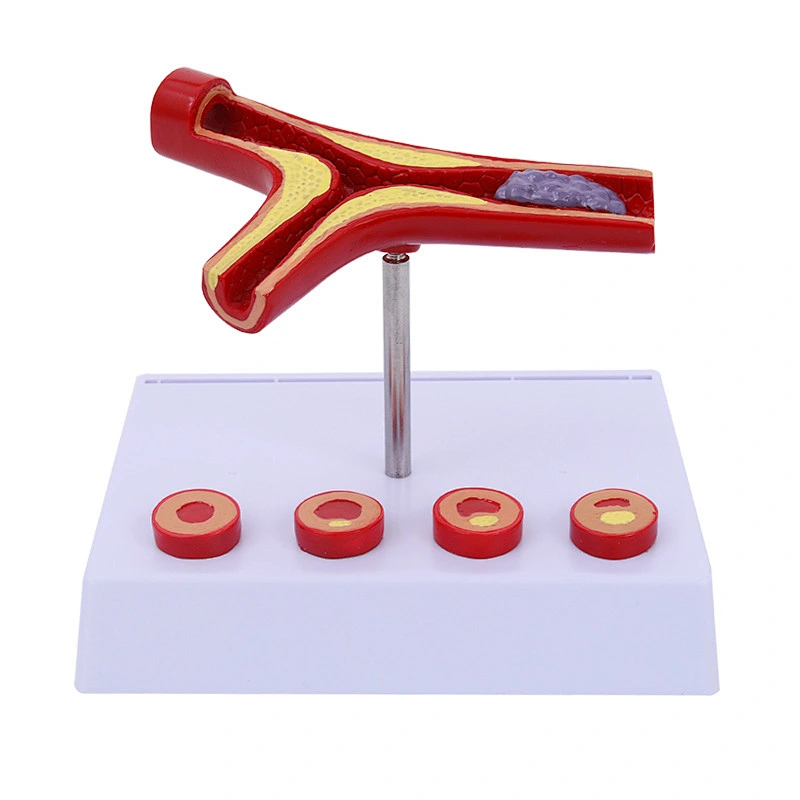 Anatomical Model Manikin Atherosclerosis Display Teaching Model Human Atherosclerosis Anatomical Model The Mannequin Display Atherosclerosis Model Teaching Aids