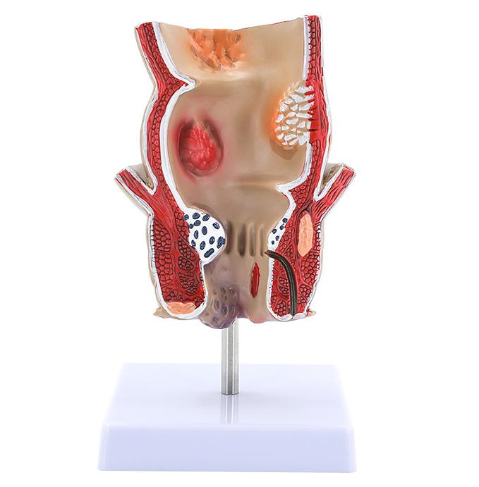 Rectum Acne Lesion Model of Human Anatomy pathological Disease Rectal Ulcer Acne pathological Model