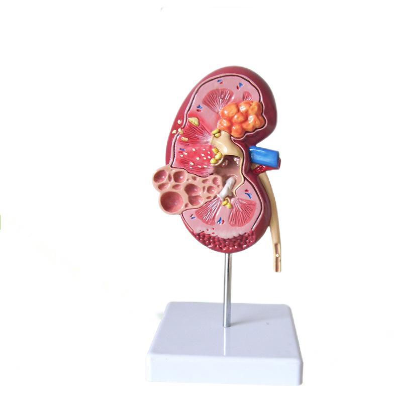 Life Size Human Kidney Anatomical Diseased Model Renal Cyst Model Cyst of Kidney Anatomy Diseased Pathological Stone Organ Teaching Supplies Learning Tool