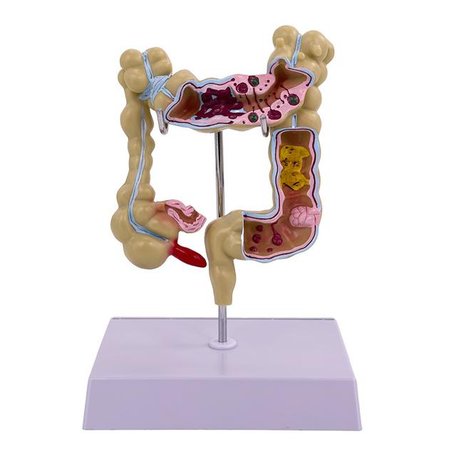 Anatomical Human Colon Intestine Pathological Diseases Model Medical Anatomy