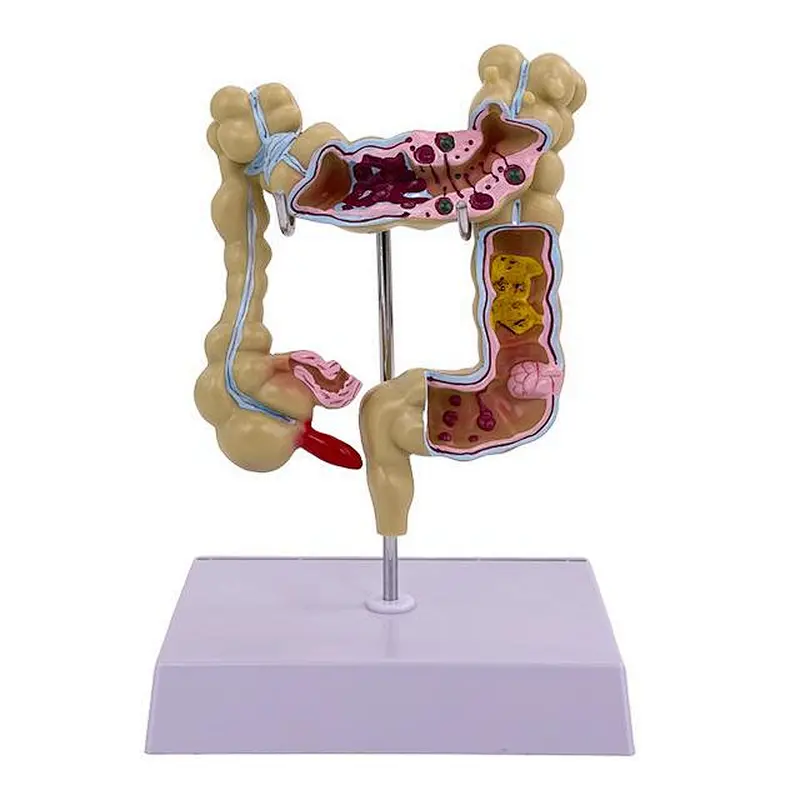 Anatomical Human Colon Intestine Pathological Diseases Model Medical Anatomy