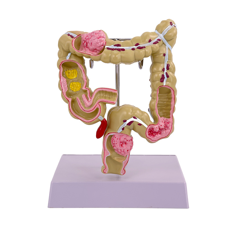 Pathological Model of Colon and Rectum